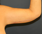 Feel Beautiful - Arm Lift San Diego 28 - After Photo